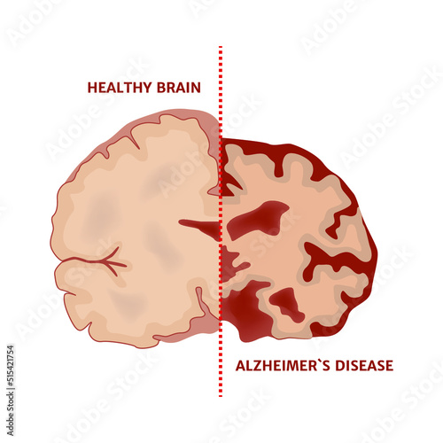Diagram with a healthy half of the brain and with Alzheimer's disease. Structural damage by disease. Medical poster. Vector illustration