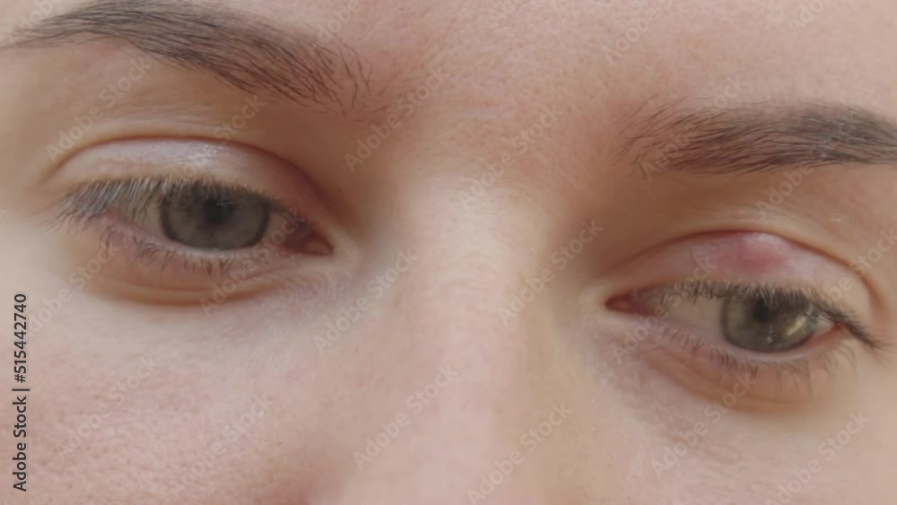  Painful red upper eye lid with onset of stye infection due. Close up of young woman with blue eye with stye infection.