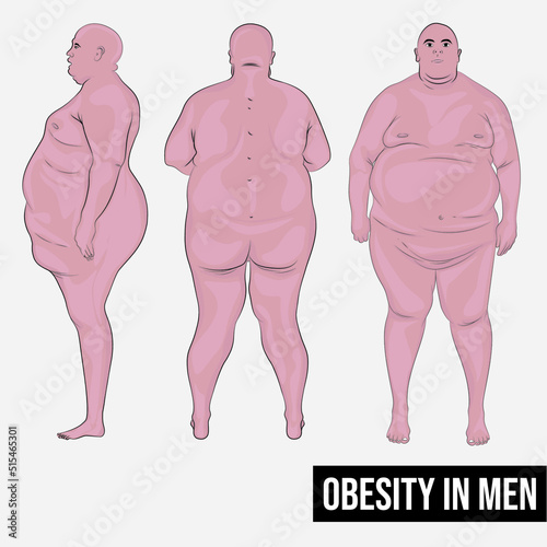 Men with morbid obesity, may suffer from physical limitations and serious health problems to perform activities.