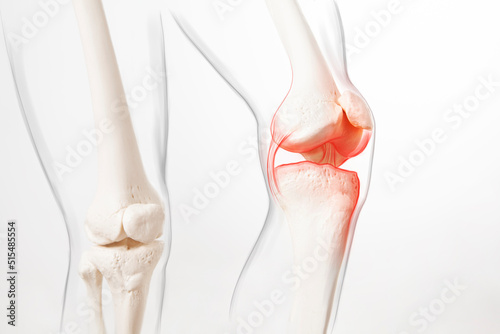 Human leg, knee meniscus, medically accurate representation of an arthritic knee joint