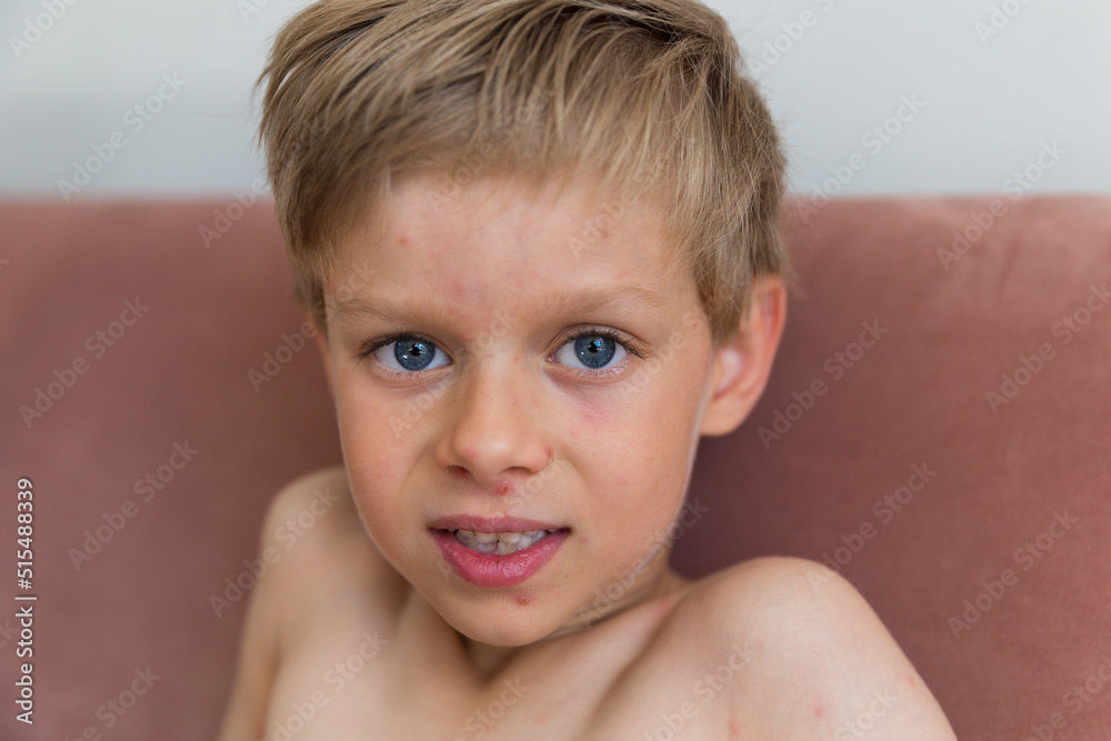 Young toddler with chickenpox. Sick child with chickenpox. Varicella virus or Chickenpox bubble rash on child. Portrait of little boy with pox. Young toddler with chickenpox. Sick child with chickenpox. Varicella virus or Chickenpox bubble rash on child. Portrait of little boy with pox.