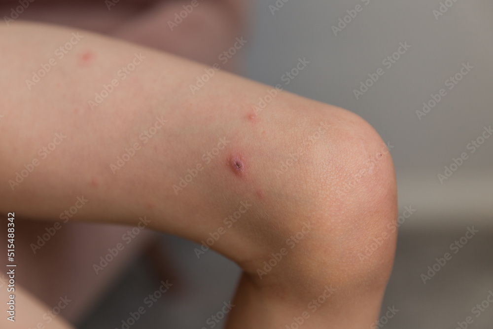 A close-up and detailed view on the knee of a little boy, red pus filled spots are seen around the upper leg, painful and red, symptomatic of chickenpox (varicella zoster virus). A close-up and detailed view on the knee of a little boy, red pus filled spots are seen around the upper leg, painful and red, symptomatic of chickenpox (varicella zoster virus).