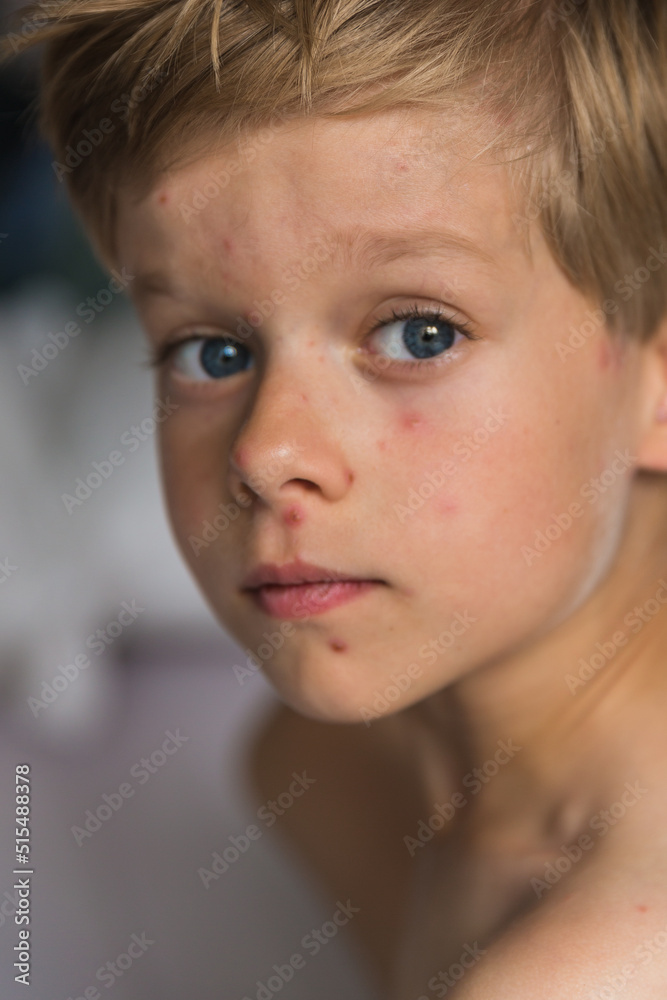 A small child with varicella virus lies in bed and looks at the camera. Varicella zoster virus. Place for text. Banner. Chickenpox concept. Medicine. Medical concept. Close up. Layout. A small child with varicella virus lies in bed and looks at the camera. Varicella zoster virus. Place for text. Banner. Chickenpox concept. Medicine. Medical concept. Close up. Layout.