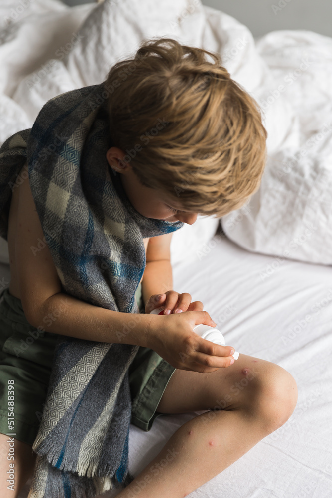 Child skin infected with chickenpox is having treatment using