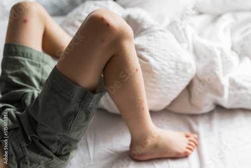 A close-up and detailed view on the knee of a little boy, red pus filled spots are seen around the upper leg, painful and red, symptomatic of chickenpox (varicella zoster virus). photo