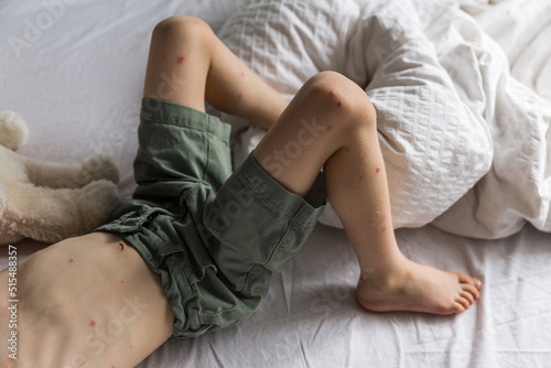 A close-up and detailed view on the knee of a little boy, red pus filled spots are seen around the upper leg, painful and red, symptomatic of chickenpox (varicella zoster virus). photo