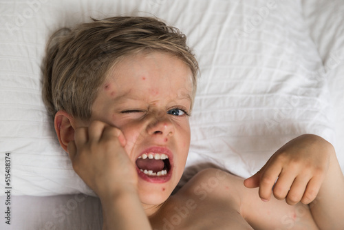 Obraz na plátně Portrait of itching little boy with chickenpox