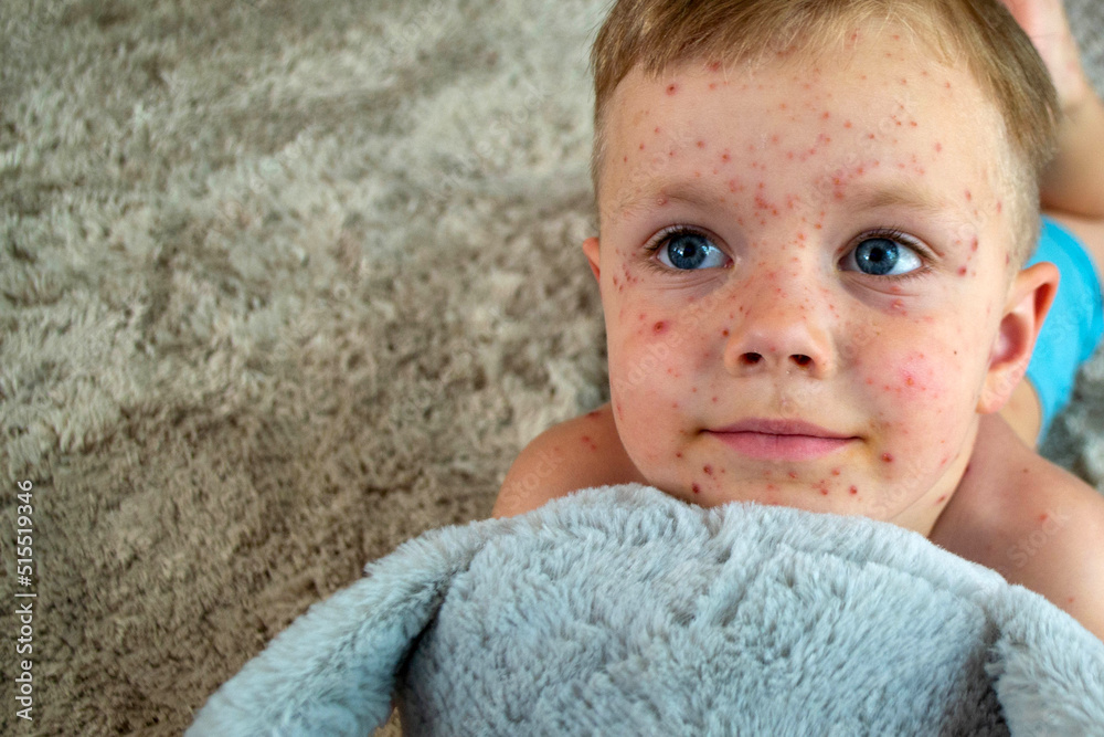 Natural vaccination. Contagious disease. Sick child with chickenpox