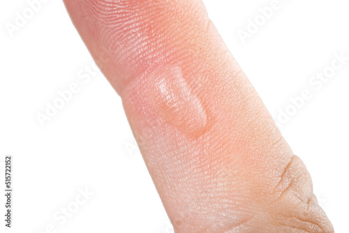 On hand finger there is blister callus or abscess. Medical trauma care concept  close up body with damage human skin isolated on white background.
