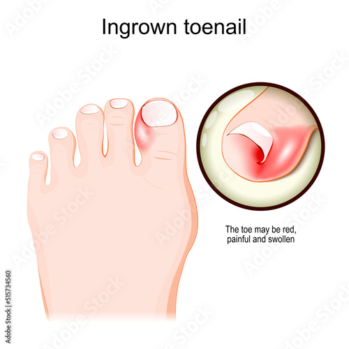 Ingrown toenail. Human foot.
