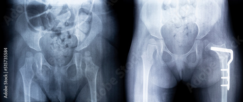 X-ray before and after surgery. Femoral osteotomy. X-ray film of the pelvis: dysplasia of the left hip, close-up of the metal plate photo