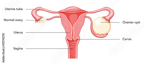 Ovarian cyst Female reproductive system uterus in Anatomical infographic diagram with inscriptions in Latin text. Human anatomy internal organs location scheme, cervix, ovary, fallopian tube flat icon