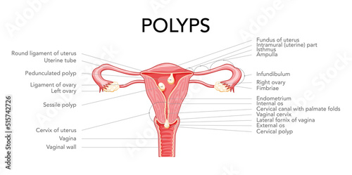 Polyp in the uterus with inscriptions diagram Female reproductive system in cross sections. Front view in a cut. Human anatomy diseases internal organs location scheme, cervix, ovary flat style icon