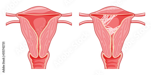 Set of Asherman syndrome Female reproductive system scar tissue adhesions in uterus. Front view in a cut. Sick and normal Human anatomy internal organs location scheme fallopian tube flat style icon