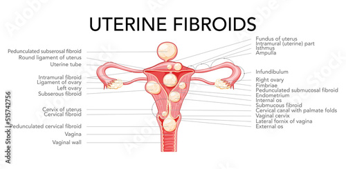 Uterine fibroids Female leiomyomas reproductive system uterus diagram with inscriptions in Latin text. Human anatomy medical illustration isolated internal organs location scheme flat style icon