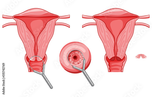 Set of Electrocoagulation diathermy of the cervical dysplasia cancer infographic Female reproductive system Carcinoma uterus. Front view. Human anatomy internal organs location scheme flat style icon