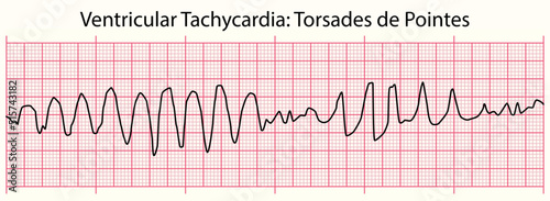 ECG: Ventricular Tachycardia Torsades de Pointes photo