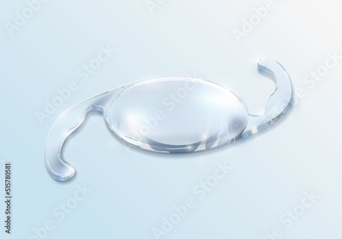 Cataract surgery, intraocular lens that will restore your vision. Corrective eyewear. Intraocular Lens Dislocation (IOL)