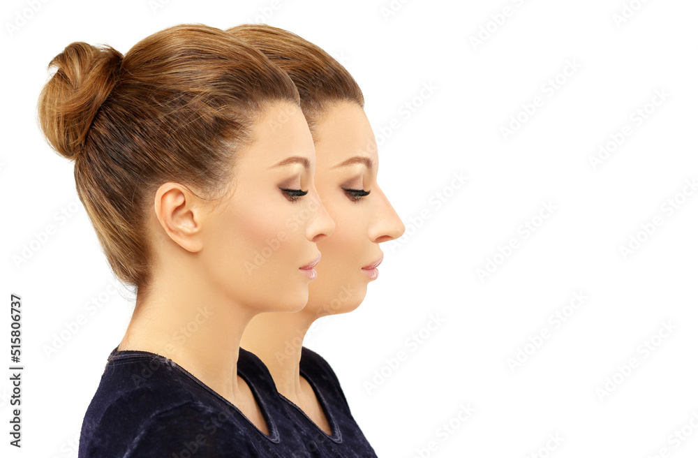 face beauty, nose and chin correction, rhinoplasty, genioplasty,Chin augmentation face beauty, nose and chin correction, rhinoplasty, genioplasty,Chin augmentation