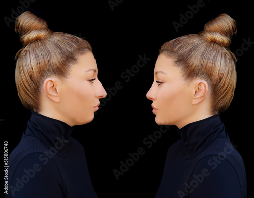 face beauty, nose and chin correction, rhinoplasty, genioplasty,Chin augmentation photo