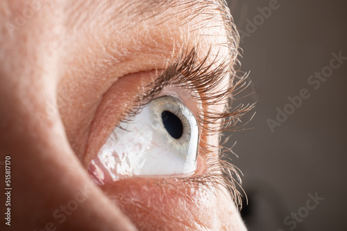 Keratoconus eye closeup , thinning of the cornea. photo