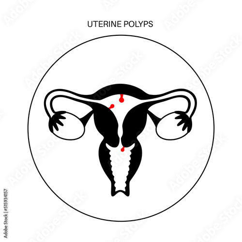 Uterus Polyps