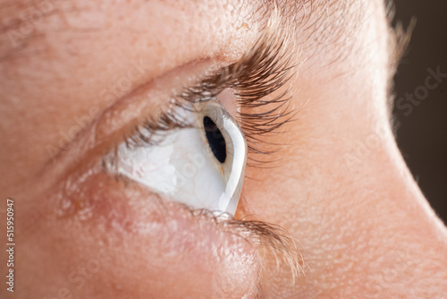 female eye diagnosed with keratoconus corneal thinning. photo