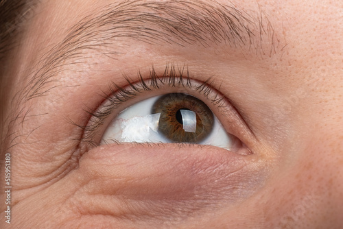 keratoconus disease of the cornea of the eye macro, fatigue corneal thinning. photo