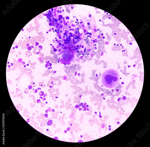 Photography Microscopic view of bone marrow slide, acute myeloid leukemia(AML), type of blood cancer,abnormal myeloblasts