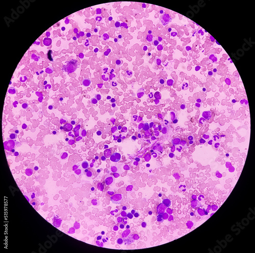 Obraz na plátne Microscopic view of bone marrow slide, acute myeloid leukemia(AML), type of blood cancer,abnormal myeloblasts
