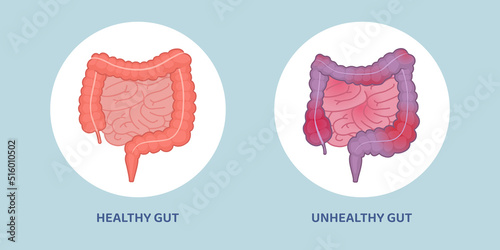 Healthy and unhealthy gut comparison photo