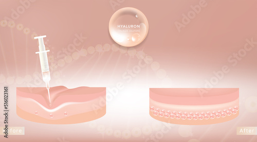 Hyaluronic acid before and after hair and skin solutions ad. botox injection into skin cells with cosmetic advertising background ready to use, illustration vector.	