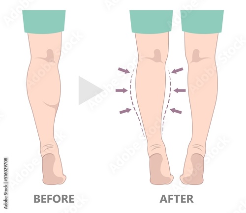 limb pain treat gastrocnemius polio leg calf resection deformity reduce slim size fat grafting transfer ankle beauty care lift male women reshapes body lose Gel neurectomy female fitness Filler toxin