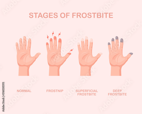Frozen hands with fingers. Stage of frostbite. Skin burn symptom. Vector illustration isolated.