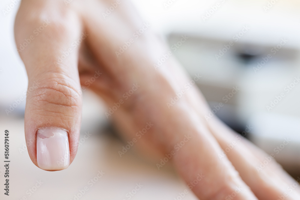 Cracked broken nail closeup. Nail weakness damage from gel polish coating. Selective focus. Cracked broken nail closeup. Nail weakness damage from gel polish coating. Selective focus.