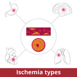 Ischemia types. Visualization of restriction in blood supply caused by problems with blood vessels due to vasoconstriction, thrombosis, or embolism.