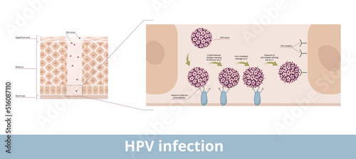 HPV infection. Process of human papillomavirus infection caused by a DNA virus from the Papillomaviridae family with its exposing and cell receptor binding stages. photo