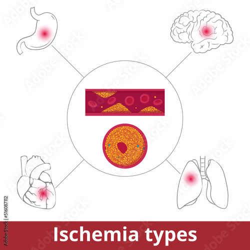 Ischemia types. Visualization of restriction in blood supply caused by problems with blood vessels due to vasoconstriction, thrombosis, or embolism.