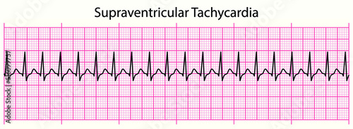 ECG line: Supraventricular Tachycardia in 6 second ECG paper line