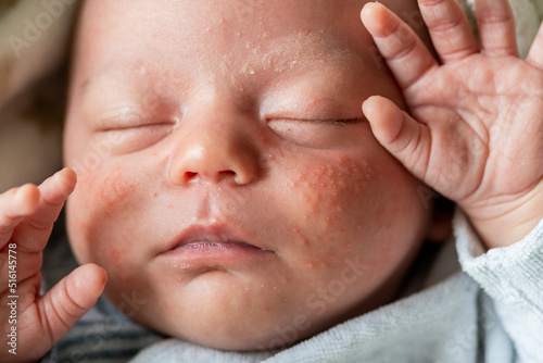 closeup of the face of a newborn baby with pimples on the cheeks due to accumulation of keratin. neonatal acne, milia, fattening. irritation and accumulation of pimples on the infant's face
