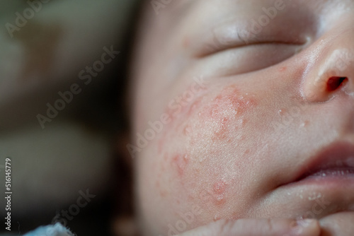 Close-up detail of the cheek of a newborn baby with neonatal acne. skin irritation with small red pimples, ezema or baby skin allergy. keratin accumulation, fattening