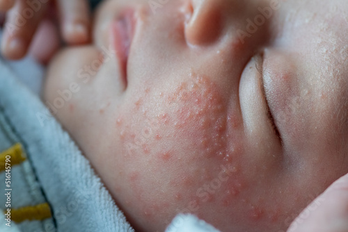 closeup of the face of a newborn baby with pimples on the cheeks due to accumulation of keratin. neonatal acne, milia, fattening. irritation and accumulation of pimples on the infant's face