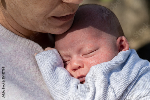 mother holding her baby with milia acne problem on face photo