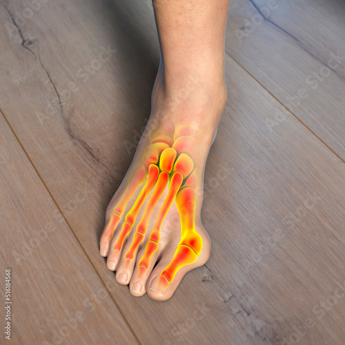 Toe deformation, also known as hallux valgus, or bunion, illustration photo