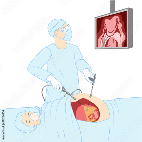 Laparoscopy keyhole surgery doctor with a patient surgical procedure Female Male reproductive system. Medical instruments with camera and screen. Human view in a cut illustration isolated flat icon