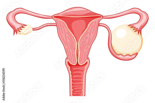 Ovarian cyst Female reproductive system uterus in Anatomical infographic. Front view in a cut gynecological disease. Human anatomy internal organs location scheme fallopian tube flat style icon