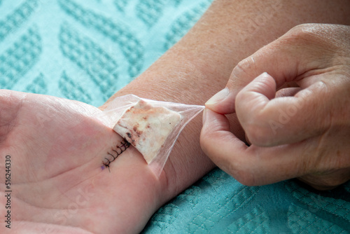 A female nurse removes a padded bandage on the wrist and hand of a woman. The palm has a number of black nylon stitches from a recent carpal tunnel surgery. The wound is closed with no infection. 