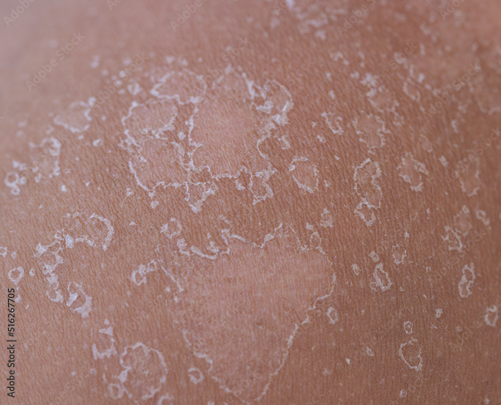 Fototapeta premium peeling of the skin after a sunburn as a background
