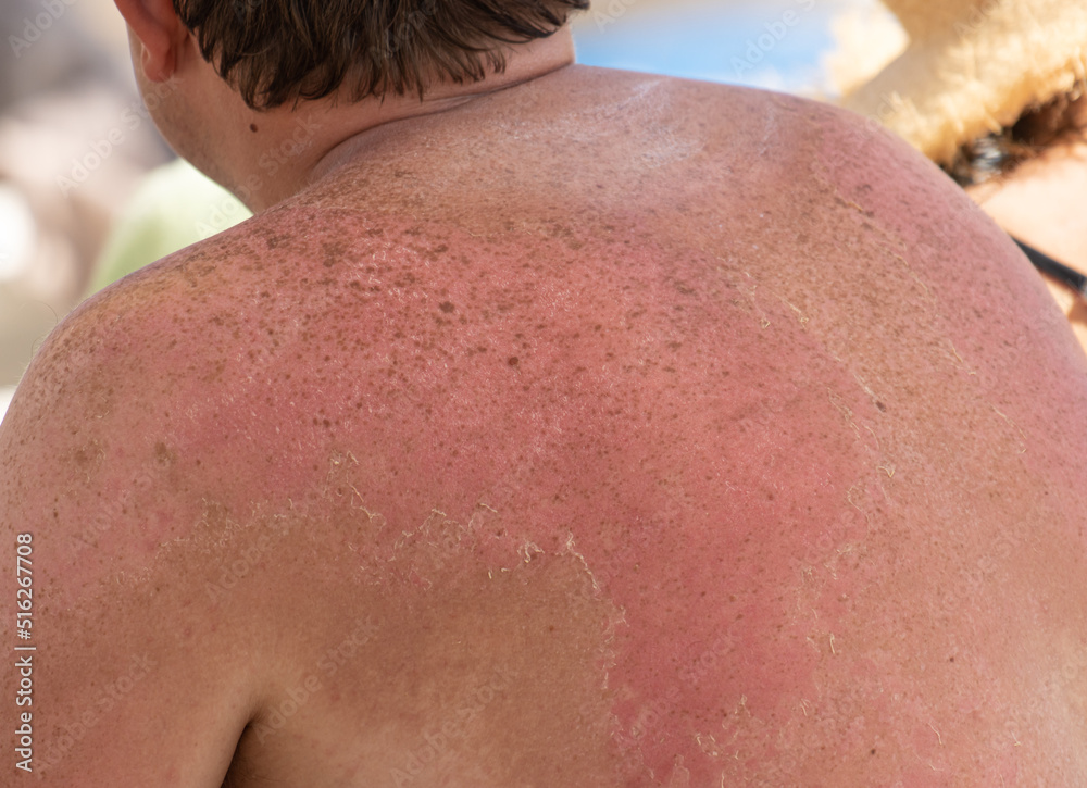 Naklejka premium peeling of the skin after a sunburn as a background