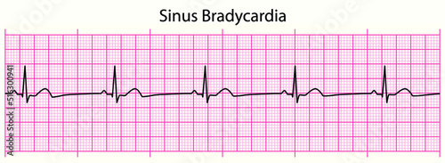 ECG line: Sinus Bradycardia in 6 second ECG paper line photo